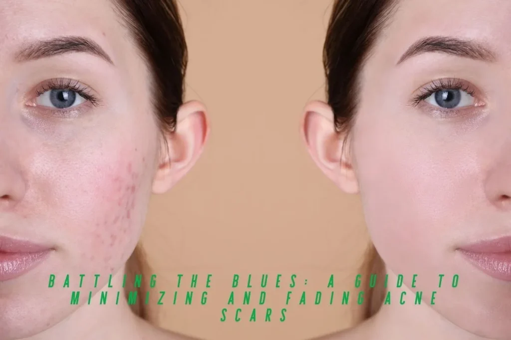 Battling the Blues A Guide to Minimizing and Fading Acne Scars