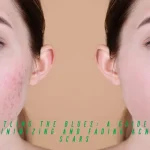 Battling the Blues A Guide to Minimizing and Fading Acne Scars